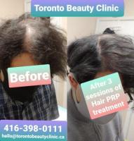 Best Mesotherapy for Hair Loss Treatment