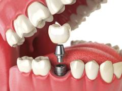 Single Tooth Implants In Mulund - Niraamay Dental Care