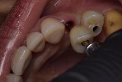 Full Mouth Dental Implants in Mexico with Teeth Savers