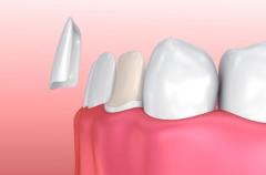 Veneers Teeth Cost in India: A Comprehensive Guide