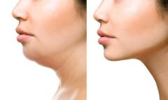 Examine One of The Top Local Face Laser Treatments in New Delhi