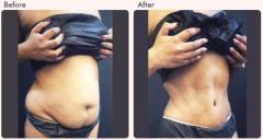 Tummy Tuck Recovery Time – The Complete Guide