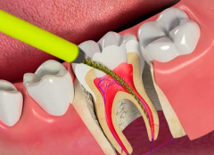 Precision Root Canal Solutions in Juhu – Trusted Care at The Smile Spa