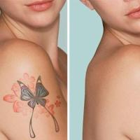 Tattoo Removal Orlando – Safe & Effective Laser Treatments