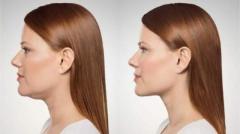 Effective Lipolaser Treatments for Double Chin Reduction