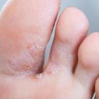 Fast Relief for Athlete's Foot and Fungal Infections