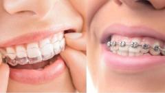 Get a Perfect Smile with Aligners In Mumbai at Aligner Point